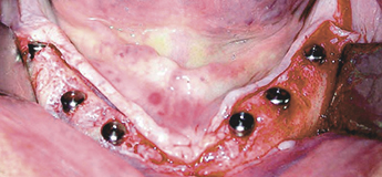 Реабилитация пациентов с выраженной атрофией челюстей с помощью имплантатов под наклоном Реабилитация пациентов с выраженной атрофией челюстей с помощью имплантатов под наклоном