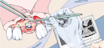 Пластическая хирургия мягких тканей в области имплантатов. Теоретический курс 