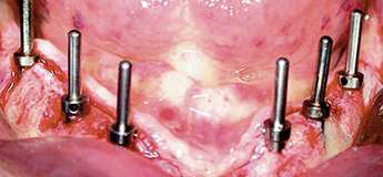 Скуловые имплантаты: показания и новые протоколы Скуловые имплантаты: показания и новые протоколы