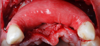 Пластика мягких тканей в области имплантатов и зубов – эстетика, эффективность, стабильность